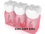 NANG CHÂN RĂNG LÀ GÌ? CÓ NGUY HIỂM KHÔNG?