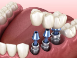 NHỮNG LƯU Ý KHI TRƯỚC VÀ SAU KHI TRỒNG RĂNG IMPLANT