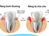 TIỀM HIỂU VỀ BỆNH VIÊM NHA CHU