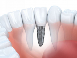 TRỒNG RĂNG IMPLANT LÀ GÌ? NHỮNG LỢI ÍCH CỦA TRỒNG RĂNG IMPLANT
