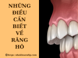 NHỮNG ĐIỀU CẦN BIẾT VỀ RĂNG HÔ 
