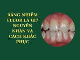RĂNG NHIỄM FLOUR LÀ GÌ? NGUYÊN NHÂN VÀ CÁCH KHẮC PHỤC