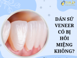 DÁN SỨ VENEER CÓ BỊ HÔI MIỆNG KHÔNG?
