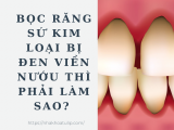 BỌC RĂNG SỨ KIM LOẠI BỊ ĐEN VIỀN NƯỚU THÌ PHẢI LÀM SAO? 