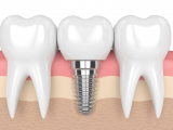 NHỮNG ĐIỀU CẦN LƯU Ý TRƯỚC VÀ SAU KHI TRỒNG RĂNG IMPLANT