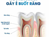 RĂNG BỊ Ê BUỐT PHẢI LÀM SAO