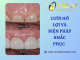 CƯỜI HỞ LỢI VÀ BIỆN PHÁP KHẮC PHỤC 