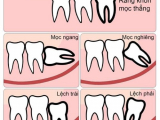 NHỮNG ĐIỀU CẦN LƯU Ý KHI ĐANG MỌC RĂNG KHÔN