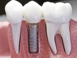TÁC HẠI CỦA  RƯỢU BIA ĐỐI VỚI IMPLANT 