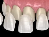 DÁN RĂNG SỨ VENEER LÀ GÌ?