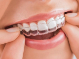 NIỀNG RĂNG TRONG SUỐT LÀ GÌ?NIỀNG RĂNG INVISALIGN CHI PHÍ THẾ NÀO?