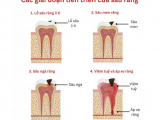 QUÁ TRÌNH SÂU RĂNG DIỄN RA NHƯ THẾ NÀO?