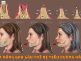 MẤT RĂNG BAO LÂU THÌ BỊ TIÊU XƯƠNG HÀM ?
