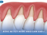 RĂNG BỊ TỤT NƯỚU PHẢI LÀM SAO?