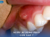  NƯỚU BỊ SƯNG PHẢI LÀM SAO ?