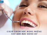 CÁCH CHĂM SÓC RĂNG MIỆNG SAU KHI BỌC RĂNG SỨ
