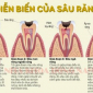 NGUYÊN NHÂN VÀ TÁC HẠI CỦA SÂU RĂNG?