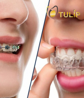 NIỀNG RĂNG INVISALIGN